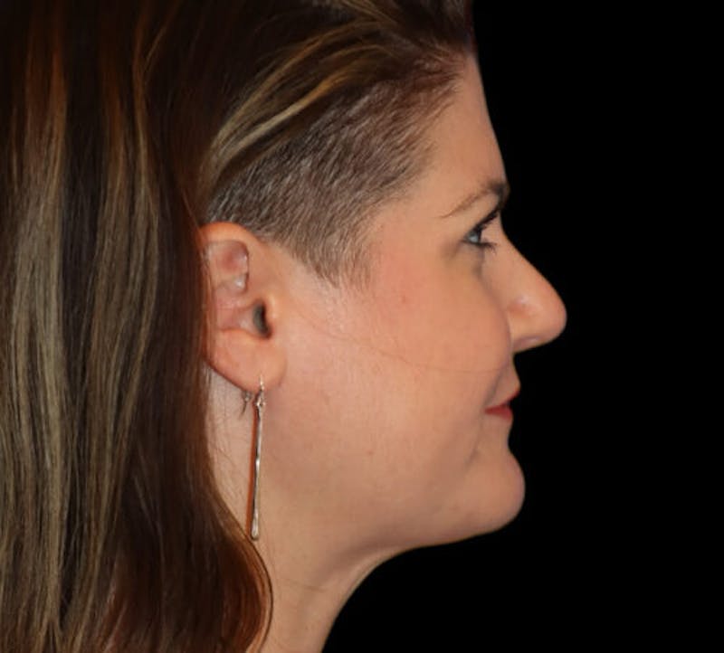 Submental (Chin) Liposuction Before & After Gallery - Patient 116375 - Image 6