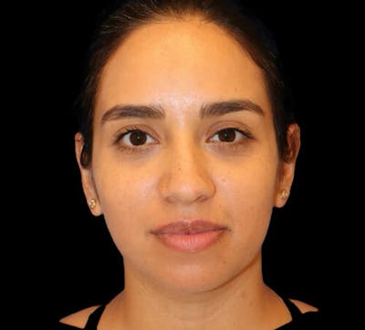 Submental (Chin) Liposuction Before & After Gallery - Patient 340986 - Image 1