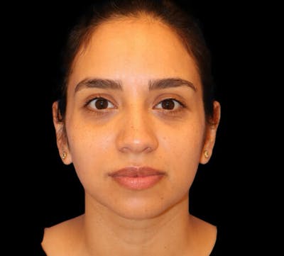 Submental (Chin) Liposuction Before & After Gallery - Patient 340986 - Image 2