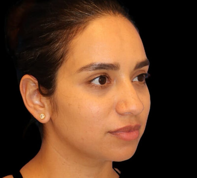 Submental (Chin) Liposuction Before & After Gallery - Patient 340986 - Image 3