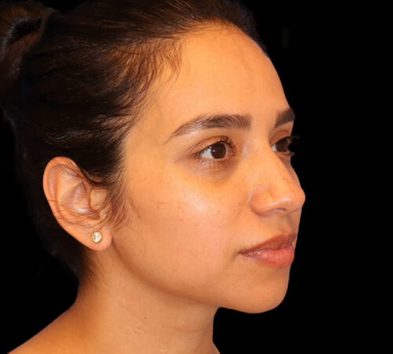 Submental (Chin) Liposuction Before & After Gallery - Patient 340986 - Image 4