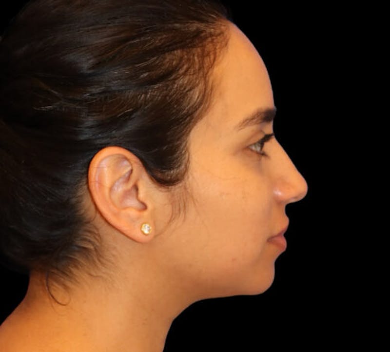 Submental (Chin) Liposuction Before & After Gallery - Patient 340986 - Image 5