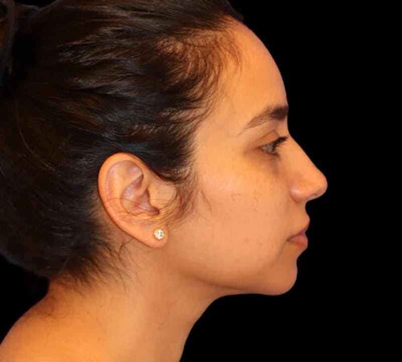 Submental (Chin) Liposuction Before & After Gallery - Patient 340986 - Image 6