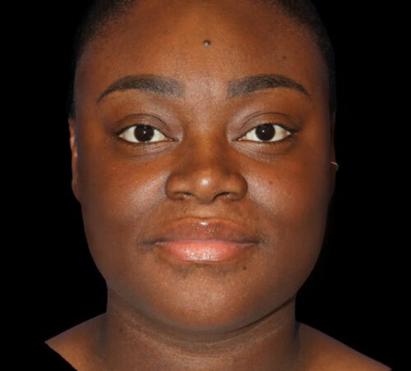 Submental (Chin) Liposuction Before & After Gallery - Patient 111329 - Image 1