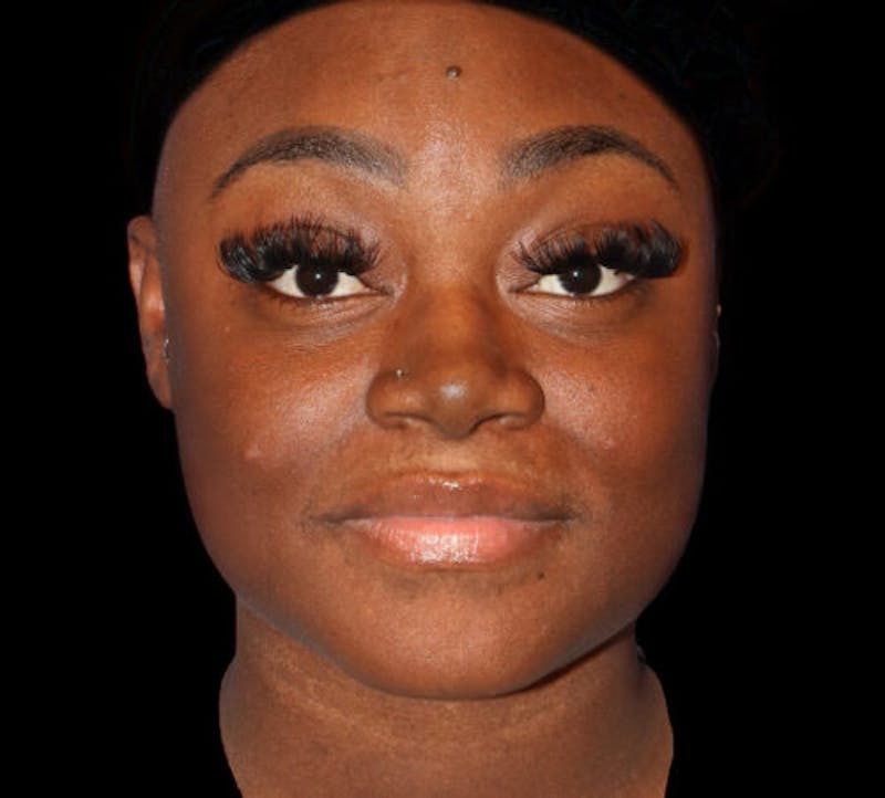 Submental (Chin) Liposuction Before & After Gallery - Patient 111329 - Image 2