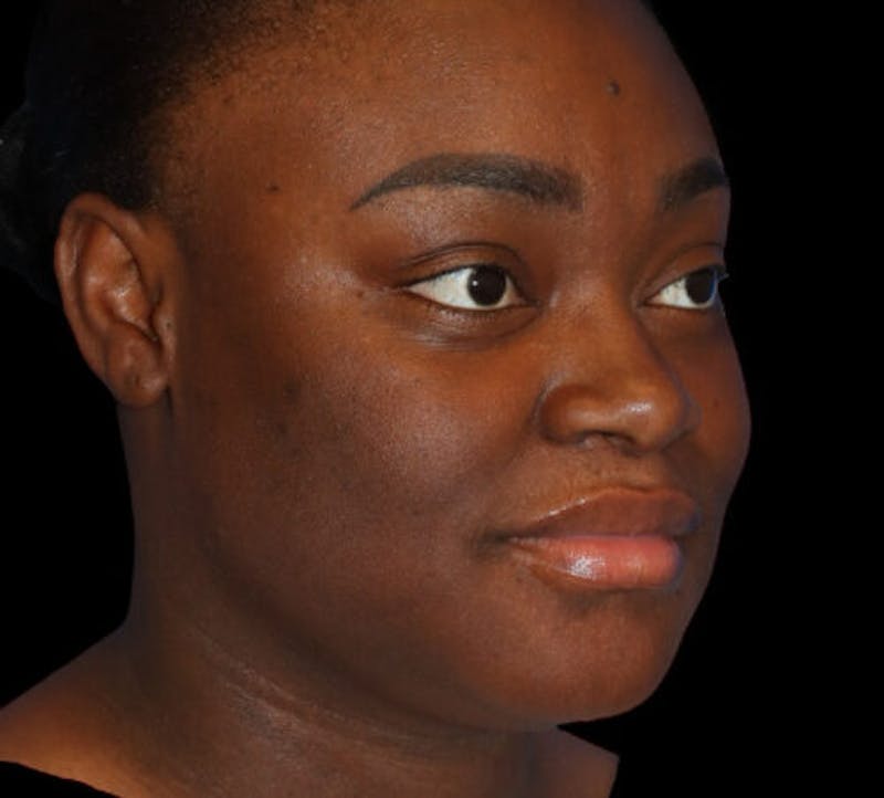 Submental (Chin) Liposuction Before & After Gallery - Patient 111329 - Image 3