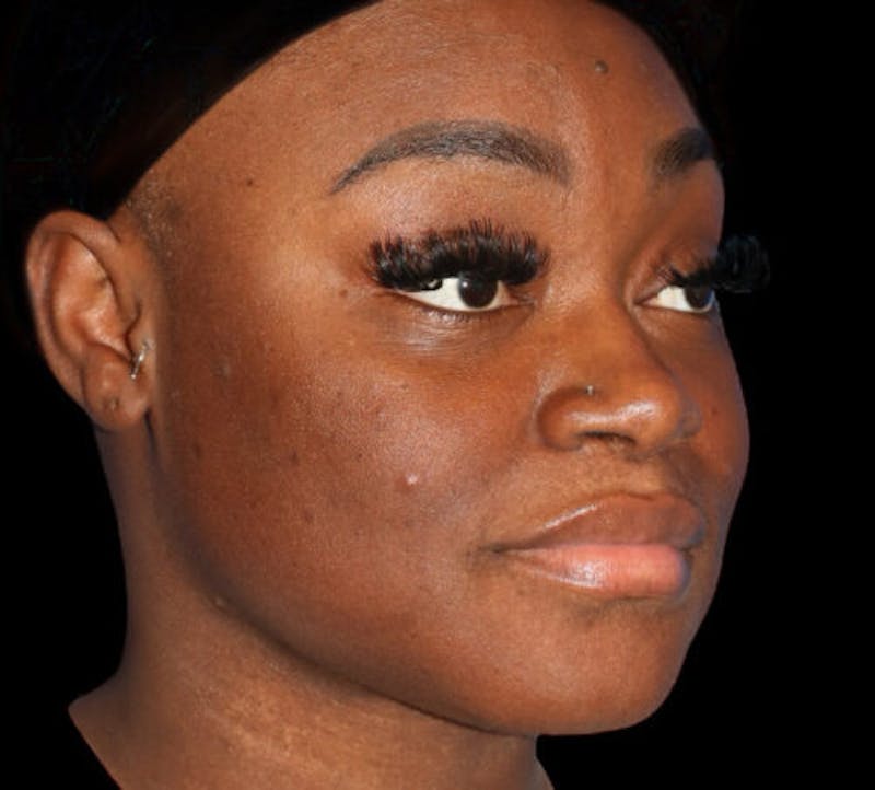 Submental (Chin) Liposuction Before & After Gallery - Patient 111329 - Image 4