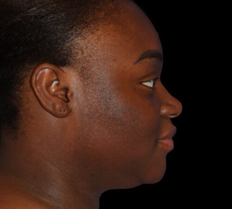 Submental (Chin) Liposuction Before & After Gallery - Patient 111329 - Image 5