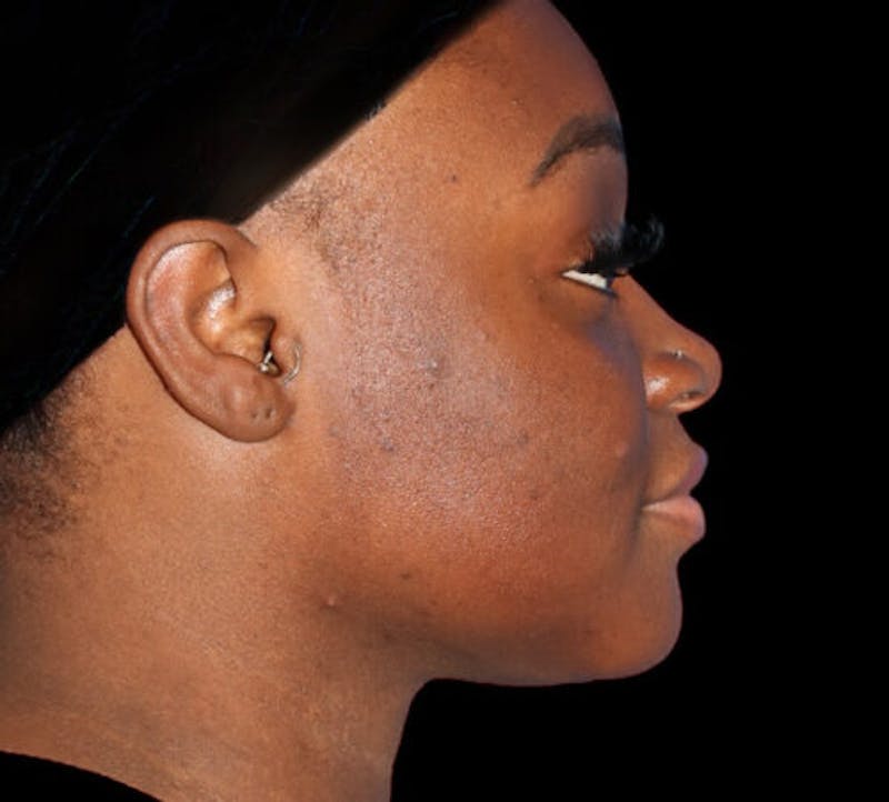 Submental (Chin) Liposuction Before & After Gallery - Patient 111329 - Image 6