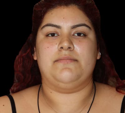 Submental (Chin) Liposuction Before & After Gallery - Patient 118636 - Image 1