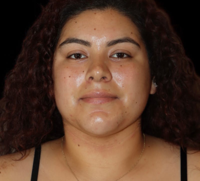 Submental (Chin) Liposuction Before & After Gallery - Patient 118636 - Image 2