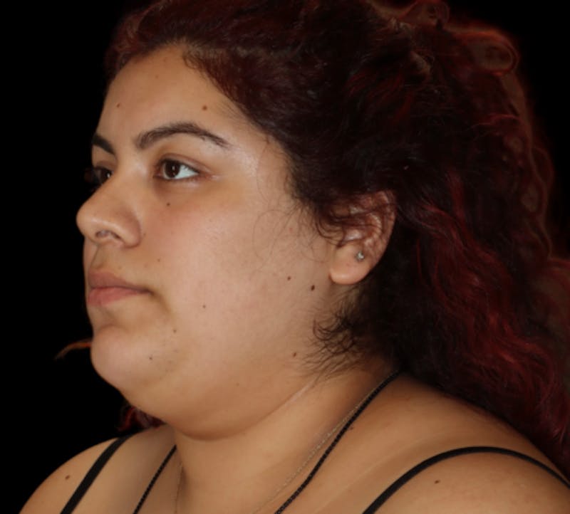 Submental (Chin) Liposuction Before & After Gallery - Patient 118636 - Image 3