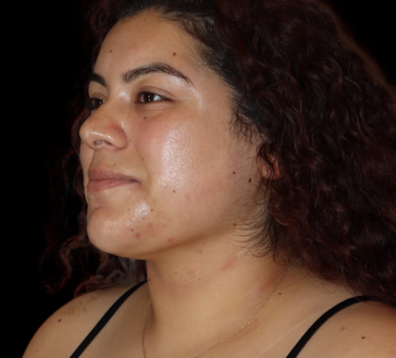 Submental (Chin) Liposuction Before & After Gallery - Patient 118636 - Image 4