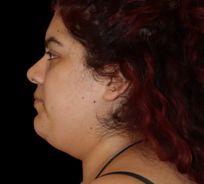 Submental (Chin) Liposuction Before & After Gallery - Patient 118636 - Image 5