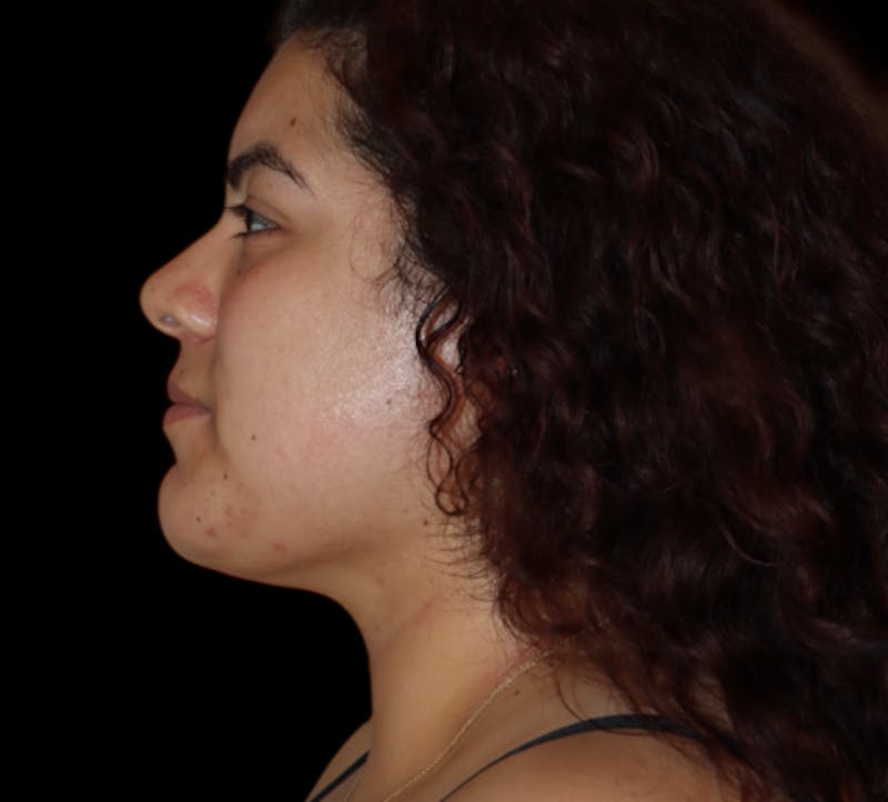 Submental (Chin) Liposuction Before & After Gallery - Patient 118636 - Image 6