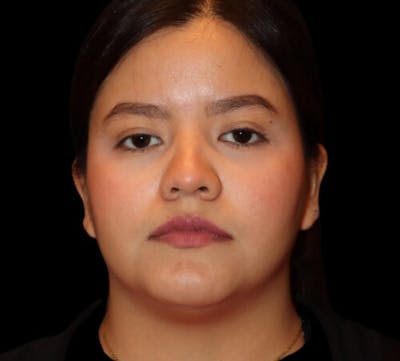 Submental (Chin) Liposuction Before & After Gallery - Patient 740389 - Image 1