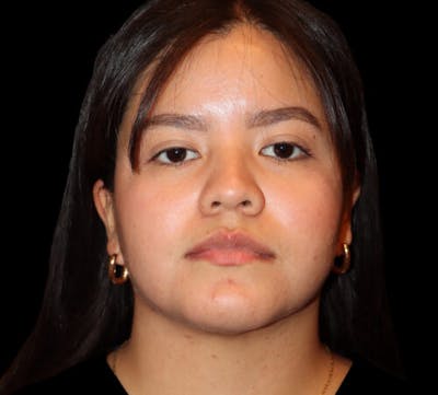 Submental (Chin) Liposuction Before & After Gallery - Patient 740389 - Image 2