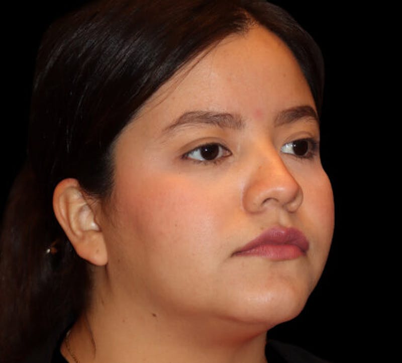 Submental (Chin) Liposuction Before & After Gallery - Patient 740389 - Image 3