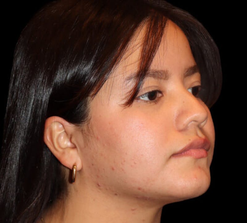 Submental (Chin) Liposuction Before & After Gallery - Patient 740389 - Image 4