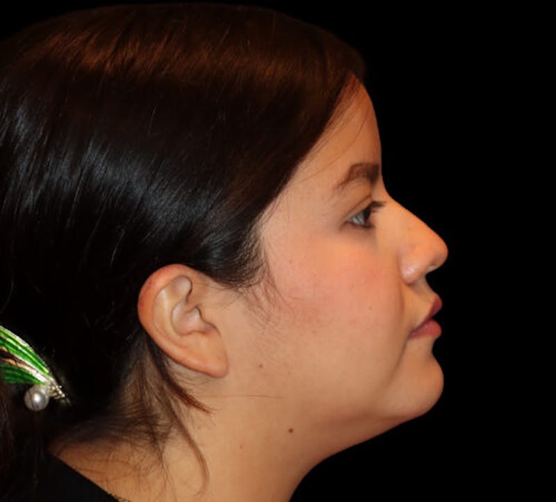 Submental (Chin) Liposuction Before & After Gallery - Patient 740389 - Image 5