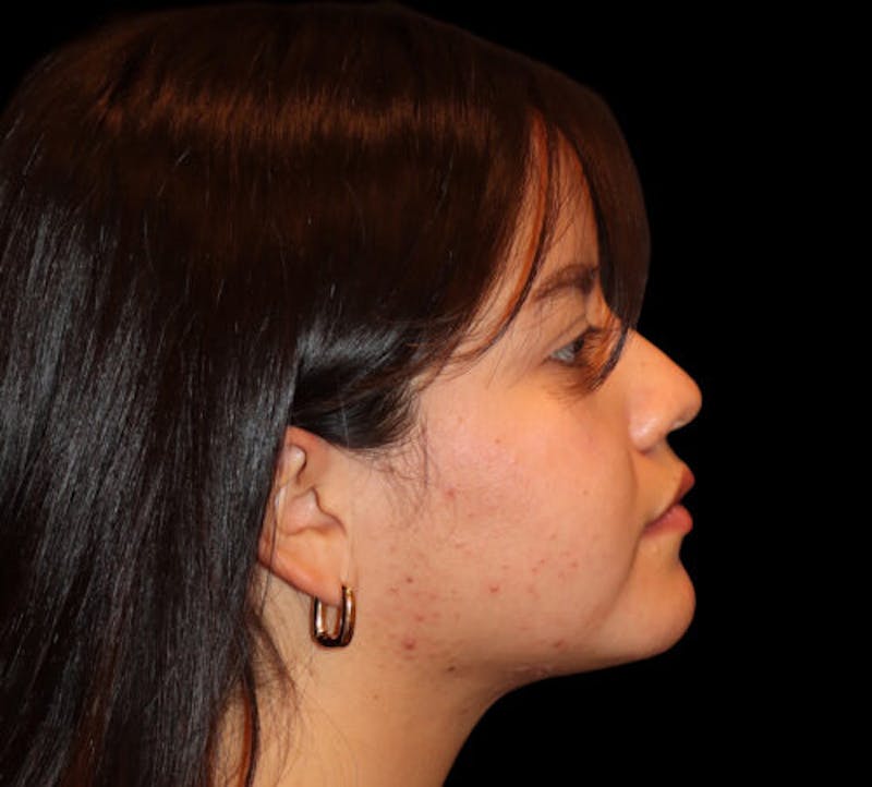 Submental (Chin) Liposuction Before & After Gallery - Patient 740389 - Image 6