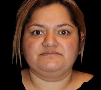 Submental (Chin) Liposuction Before & After Gallery - Patient 848377 - Image 1