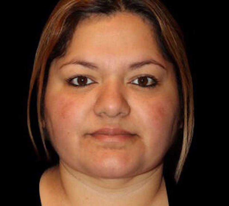 Submental (Chin) Liposuction Before & After Gallery - Patient 848377 - Image 2