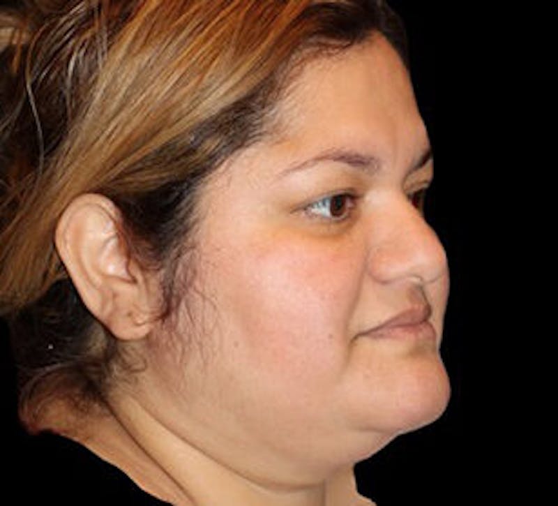 Submental (Chin) Liposuction Before & After Gallery - Patient 848377 - Image 3