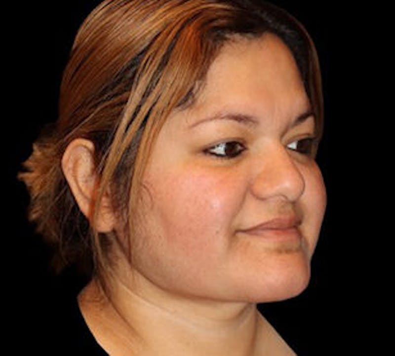 Submental (Chin) Liposuction Before & After Gallery - Patient 848377 - Image 4