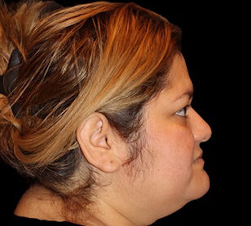 Submental (Chin) Liposuction Before & After Gallery - Patient 848377 - Image 5