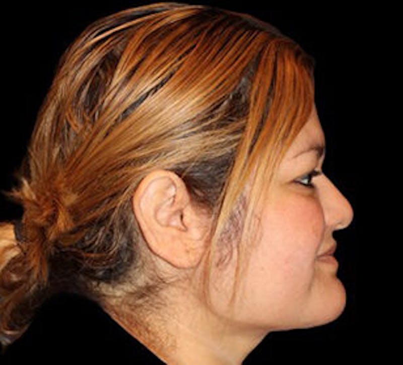 Submental (Chin) Liposuction Before & After Gallery - Patient 848377 - Image 6