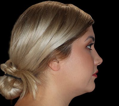 Submental (Chin) Liposuction Before & After Gallery - Patient 292172 - Image 1