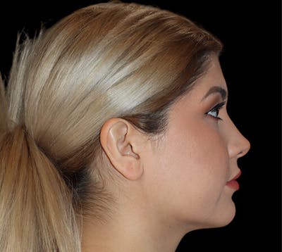 Submental (Chin) Liposuction Before & After Gallery - Patient 292172 - Image 2