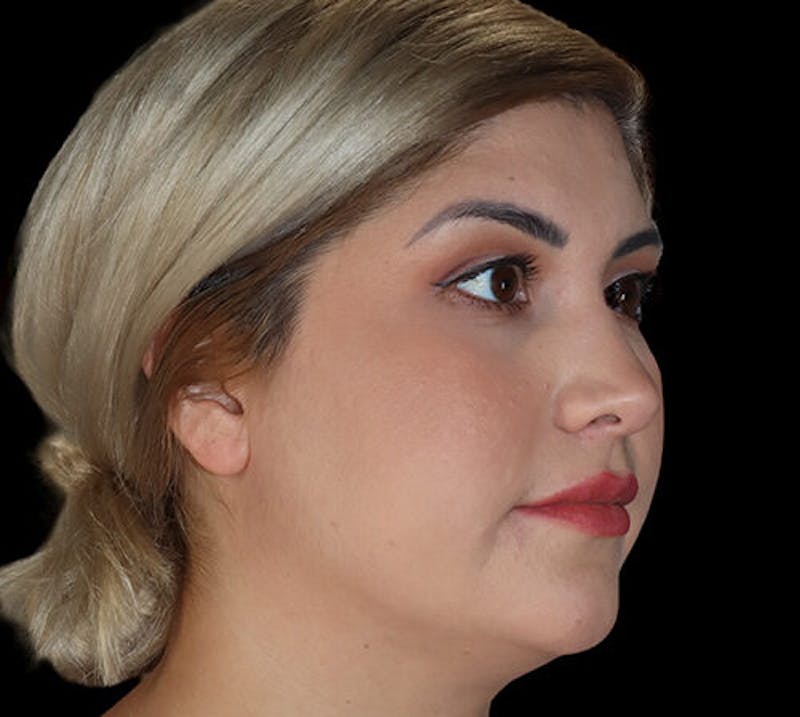Submental (Chin) Liposuction Before & After Gallery - Patient 292172 - Image 3