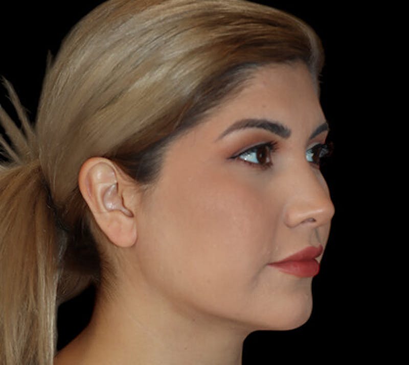 Submental (Chin) Liposuction Before & After Gallery - Patient 292172 - Image 4