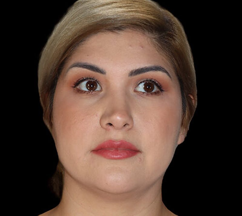 Submental (Chin) Liposuction Before & After Gallery - Patient 292172 - Image 5
