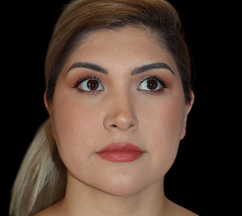 Submental (Chin) Liposuction Before & After Gallery - Patient 292172 - Image 6
