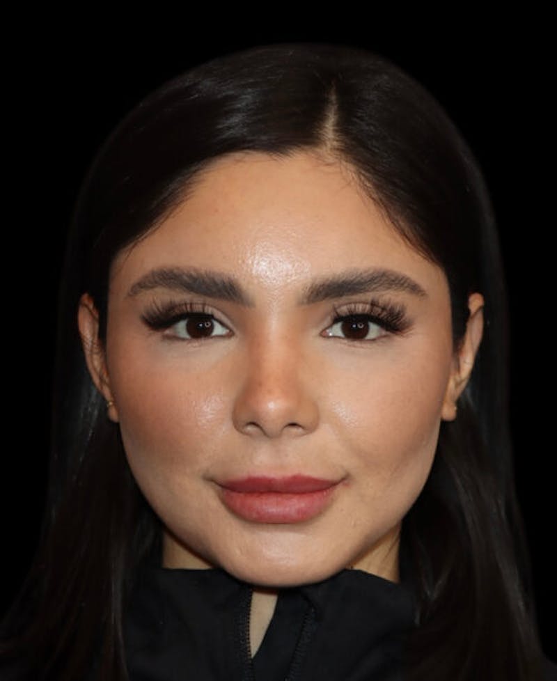 Facial Optimization Before & After Gallery - Patient 428606 - Image 1