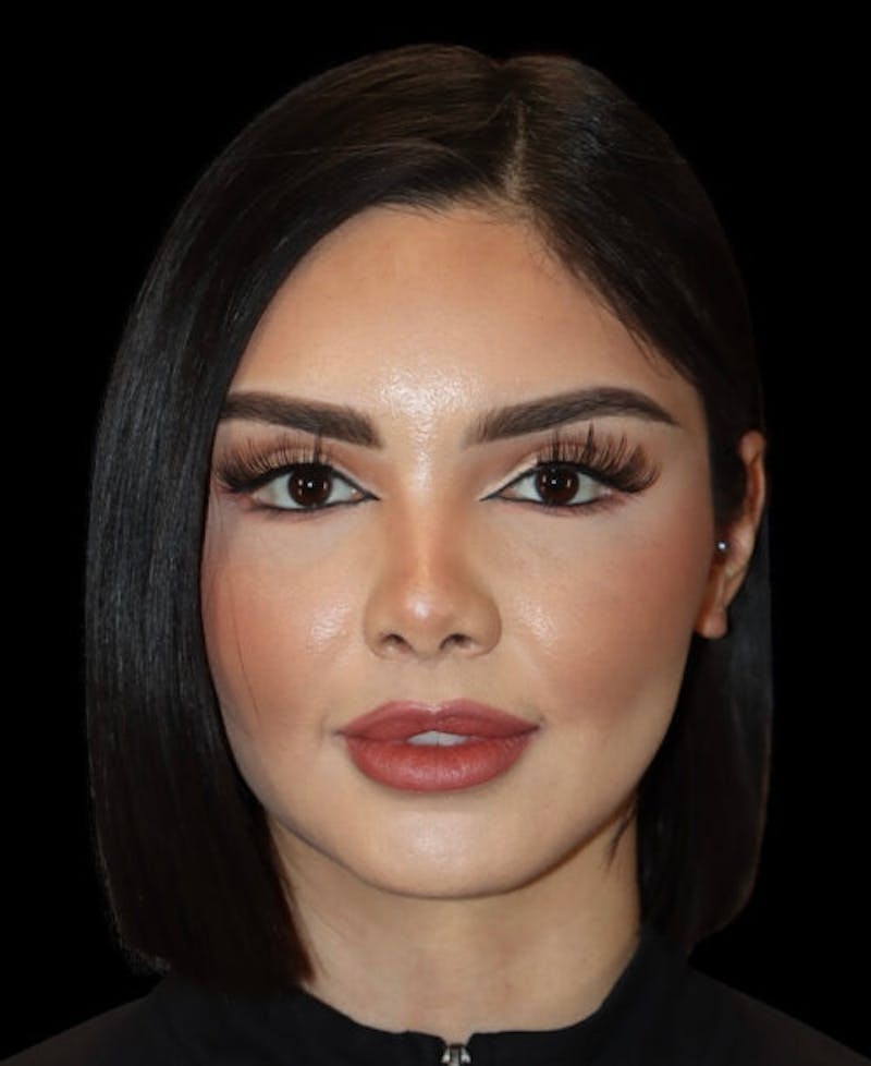 Facial Optimization Before & After Gallery - Patient 428606 - Image 2