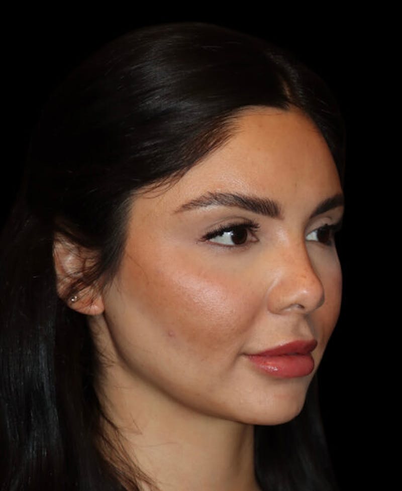 Facial Optimization Before & After Gallery - Patient 428606 - Image 3