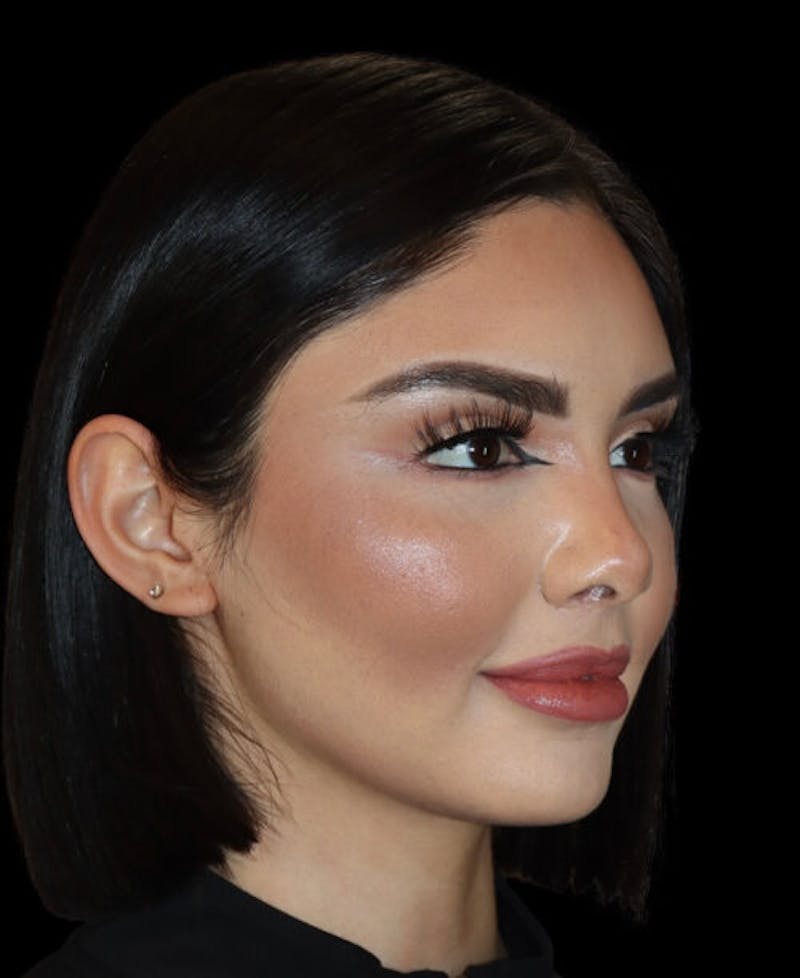 Facial Optimization Before & After Gallery - Patient 428606 - Image 4