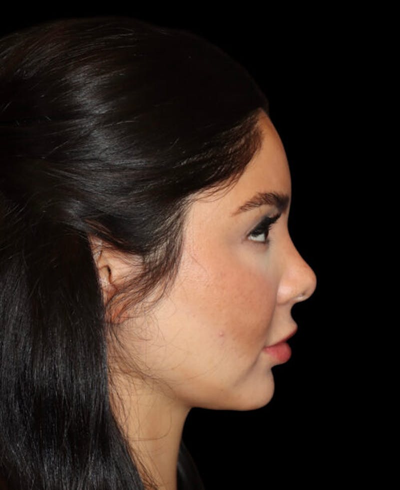 Facial Optimization Before & After Gallery - Patient 428606 - Image 5