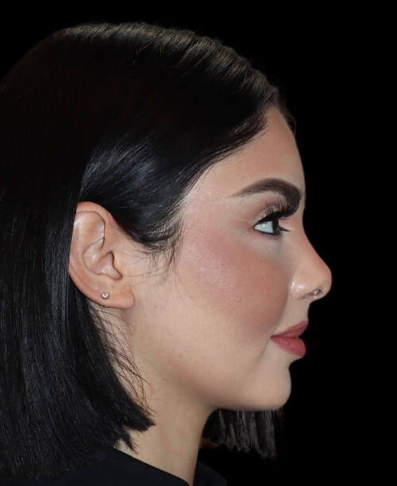 Facial Optimization Before & After Gallery - Patient 428606 - Image 6