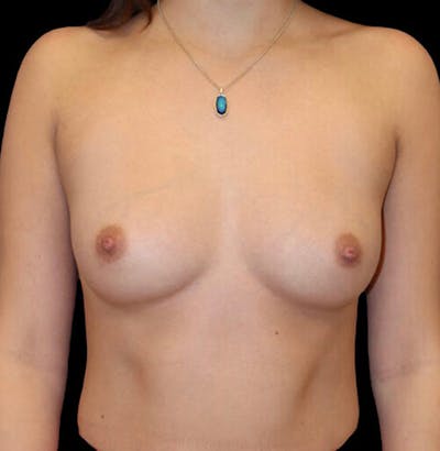 Breast Augmentation Before & After Gallery - Patient 132447 - Image 1