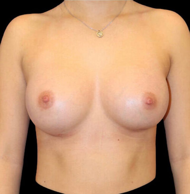 Breast Augmentation Before & After Gallery - Patient 132447 - Image 2