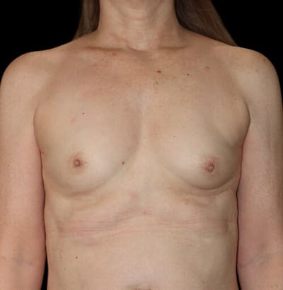 Breast Augmentation Before & After Gallery - Patient 890418 - Image 1