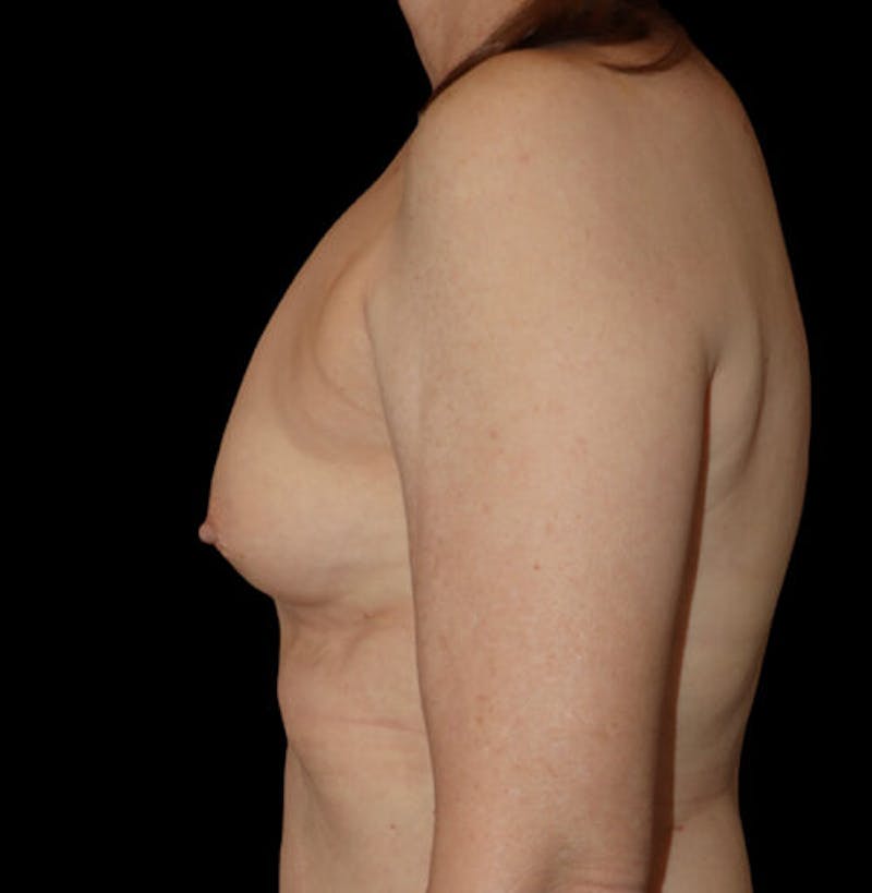 Breast Augmentation Before & After Gallery - Patient 890418 - Image 5