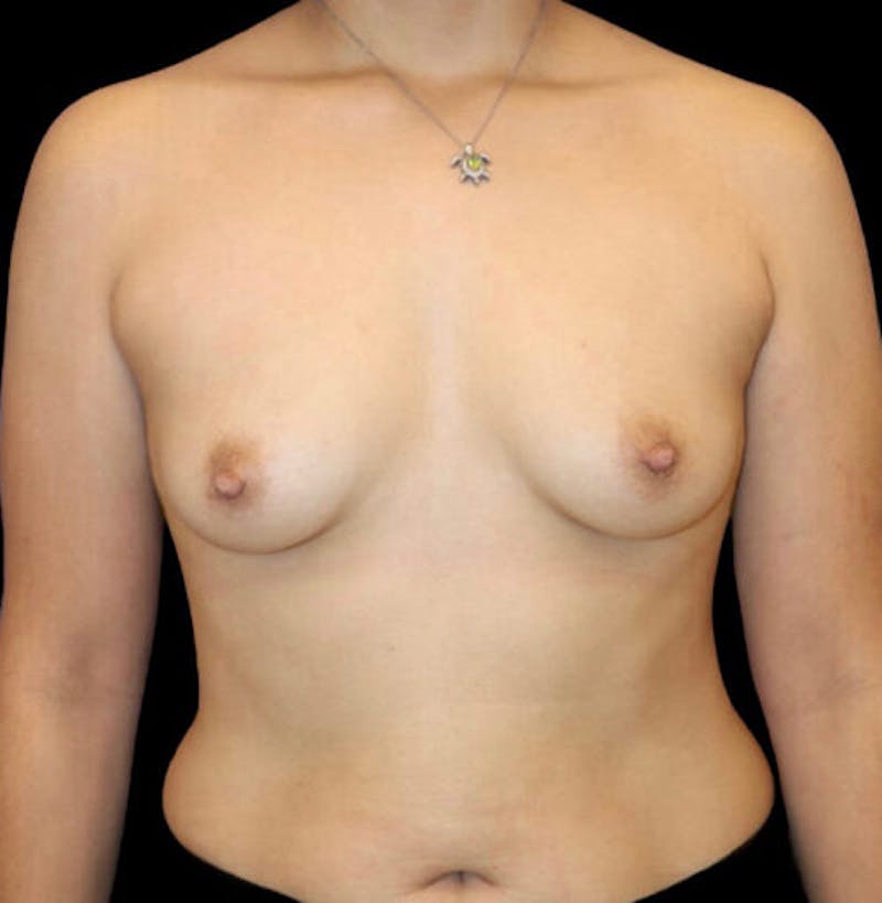 Breast Augmentation Before & After Gallery - Patient 283167 - Image 1