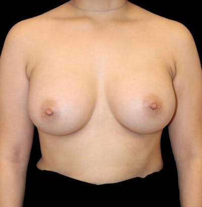 Breast Augmentation Before & After Gallery - Patient 283167 - Image 2