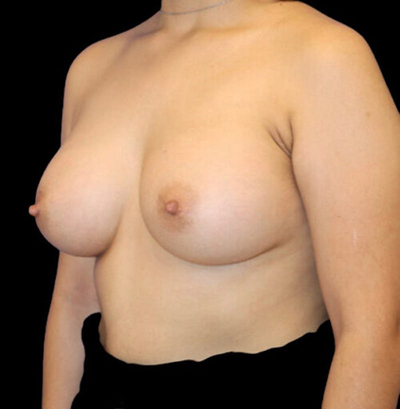 Breast Augmentation Before & After Gallery - Patient 283167 - Image 4